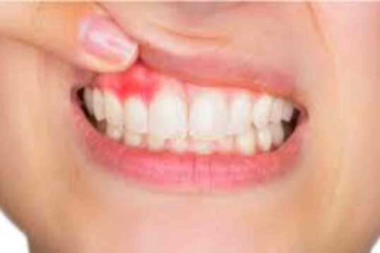 Pictures of Gum Boils (1)