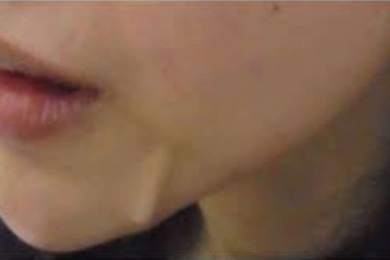 Thread Lift Gone Wrong