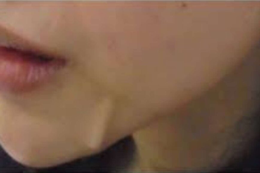 Thread Lift Gone Wrong