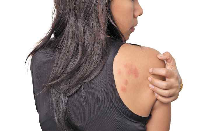 What Are Hives_ (1)