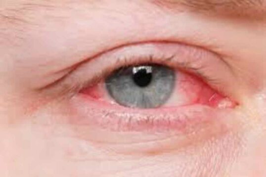 What is Commonly Misdiagnosed as Pink Eye