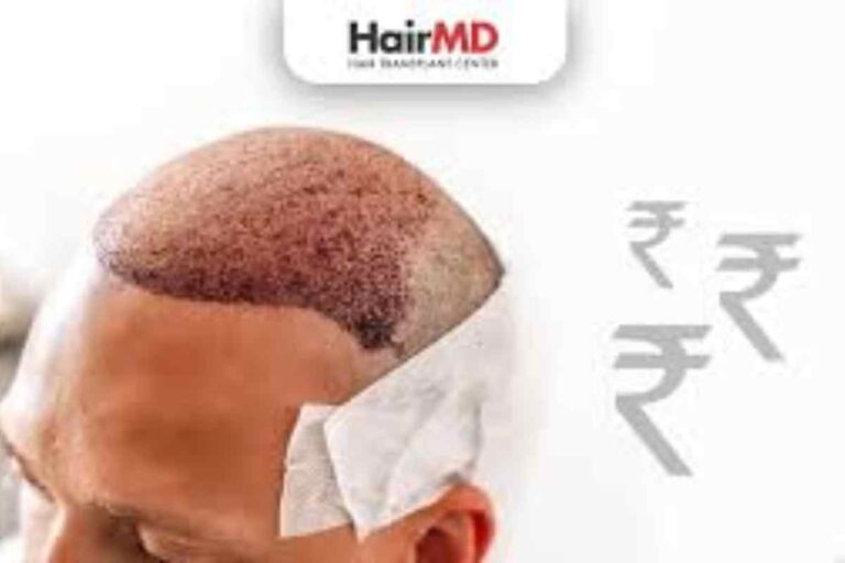 Cost of Hair Transplant in India – Details