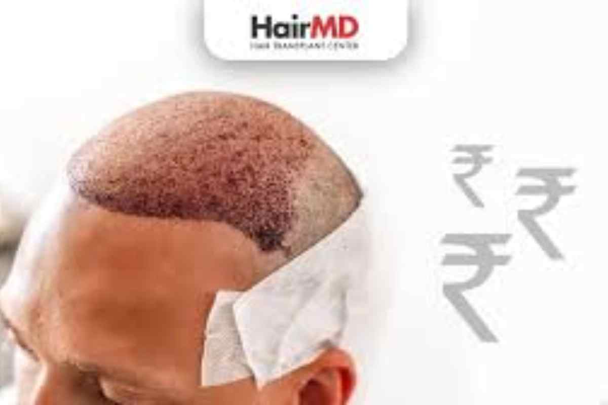 Cost of Hair Transplant in India