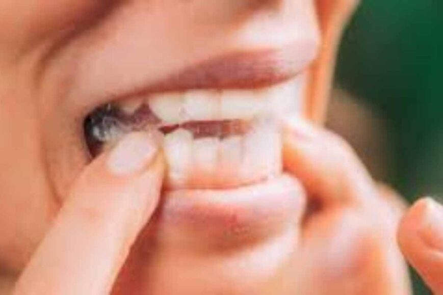 Do Whitening Strips Work_