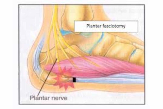 Plantar Fasciitis Surgery