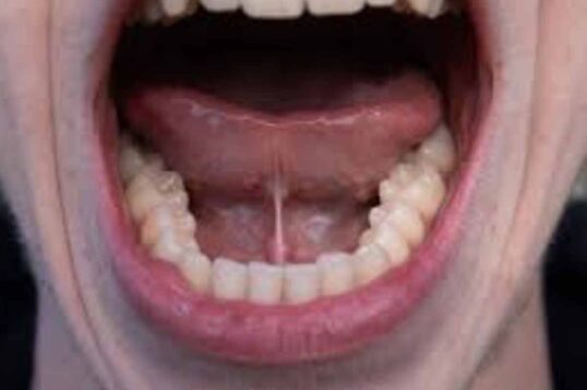 Tongue Tie Vs. Normal Adults