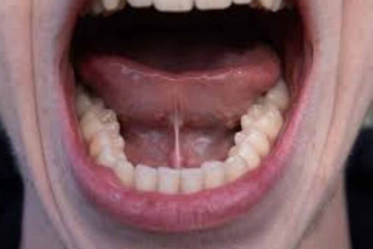 Tongue Tie Vs. Normal Adults
